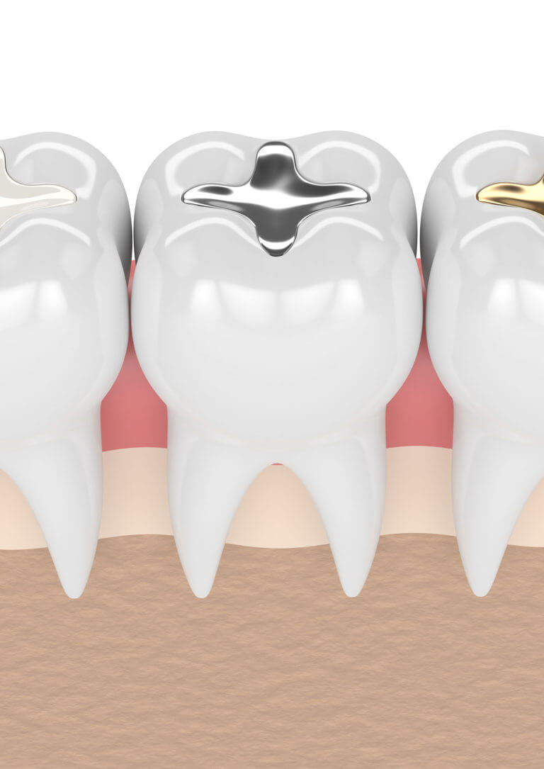 Füllungen Zahnarzt Trudering