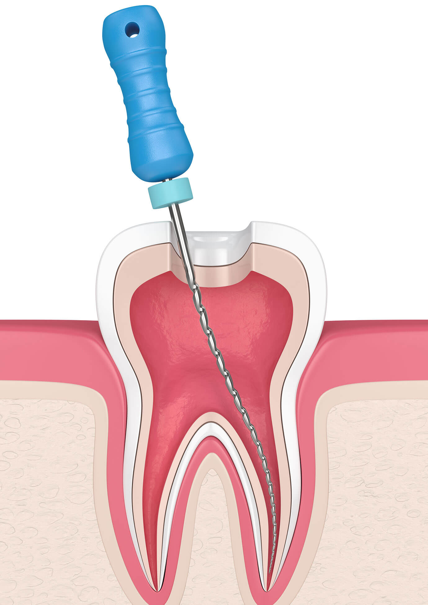 Wurzelkanalbehandlung München Endodontologie - Zahnarzt Trudering